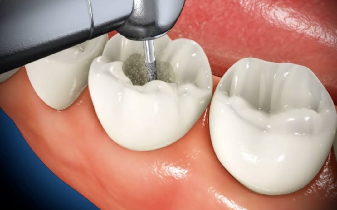 Root Canal Payment Plan Options | Root Canal Financing | Best Dental in Houston, TX